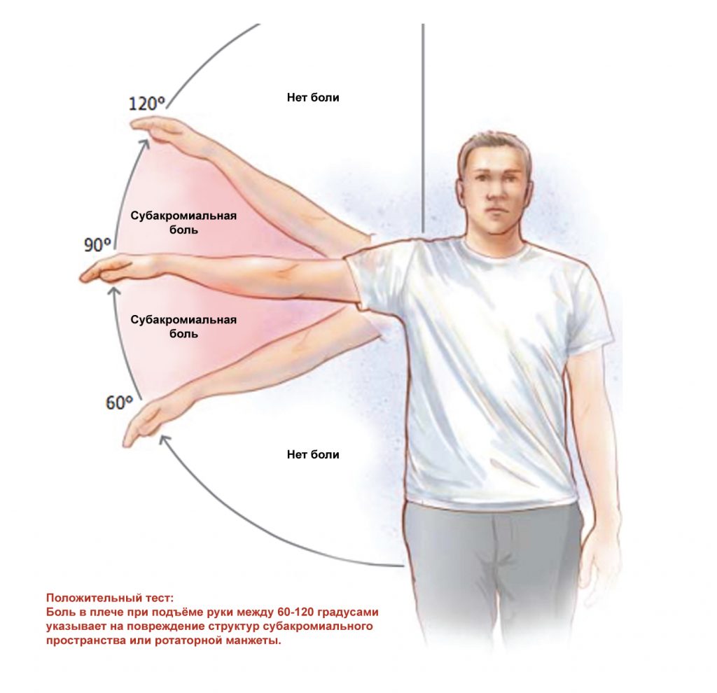 субакромиальный болевой синдром