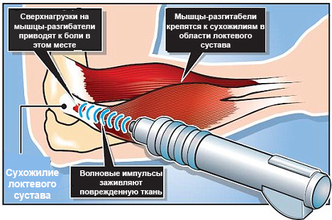 Эпикондилит локтевого сустава