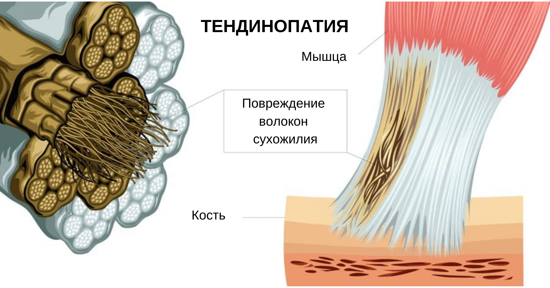 Тендинопатия что это. Тендинопатия сухожилия. Пластинчатое сухожилие.