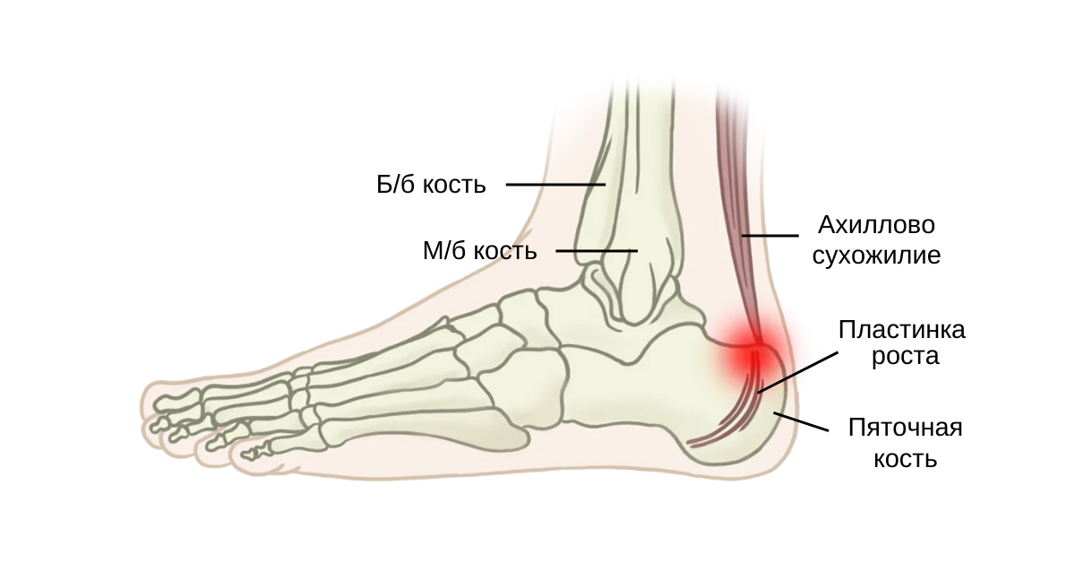 Боль при ходьбе в голеностопном суставе. Таранная кость стопы. Остеохондропатия пяточной кости Хаглунда Шинца. Пяточное ахиллово сухожилие функции. Ахиллово пяточный бурсит.