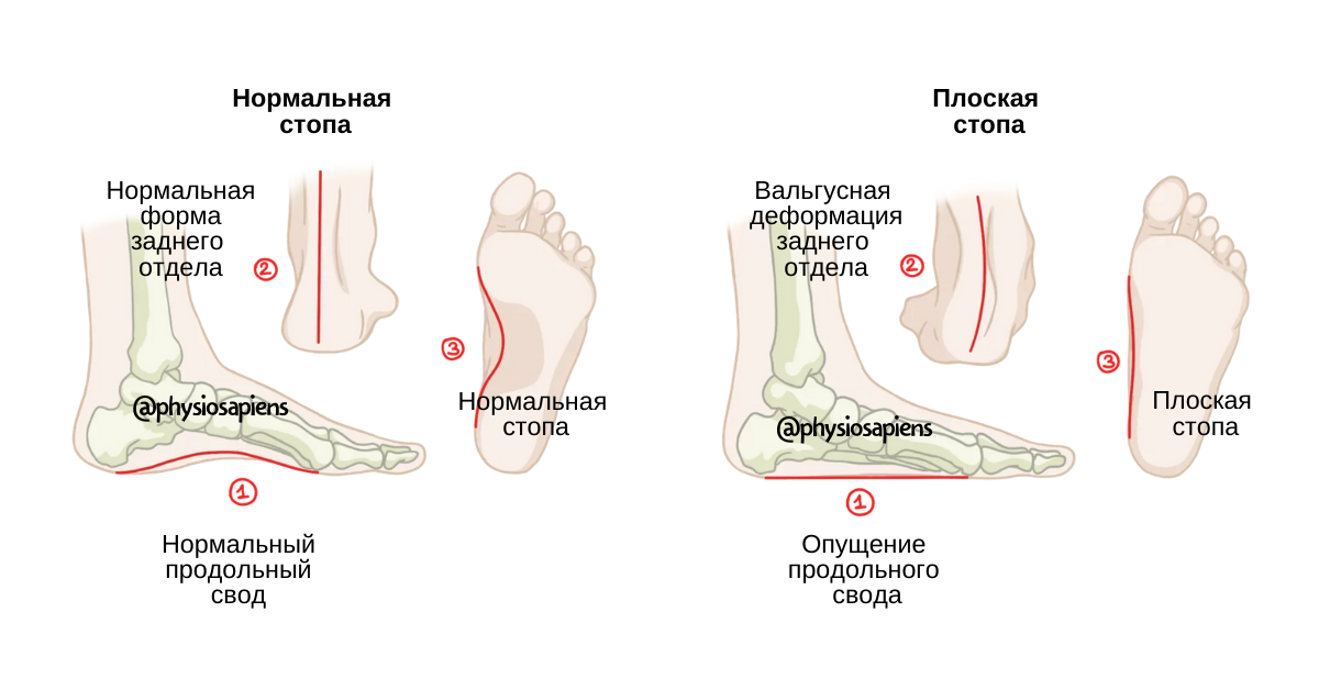 Как получить стопу. Плоскостопие поперечного свода стопы. Продольный свод стопы плоскостопие. Продольное плоскостопие деформация стопы. Плоскостопие вальгусная деформация.